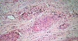 Three-pronged approach could eliminate cervical cancer within 100 years CervicalCancer