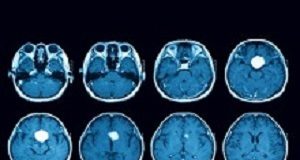 Tests show brain changes in US government personnel in Cuba MRI
