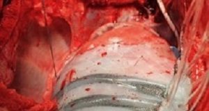 Soft robot sleeve helps the heart to beat HeartSleeve