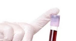 Blood test has potential to detect ovarian cancer Bloodtest