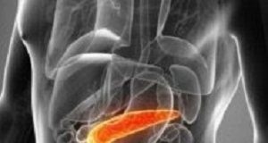 Device successful in diagnosing early pancreatic cancer PancreaticCancer