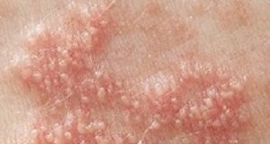 Asthma drug effective for patients with urticaria EdPickUrticaria