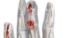 New drug helps control symptoms in psoriatic arthritis patients EDPsoriatic