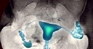 100-year-old technique has 'significant benefits' for fertility FocusFallopianFlush