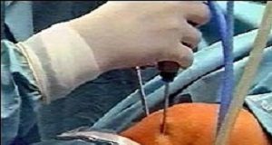 Strong recommendation against knee arthroscopy FocusKeyhole