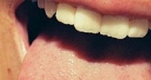 First clinical trail on therapeutic benefits of Ecstasy’s active ingredient on alcoholics Ecstacy