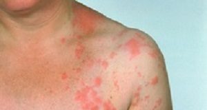 Contracting shingles doubles stroke and heart attack risk Shingles