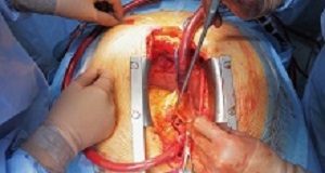 Closure of left atrial appendage should be regular part of heart surgery Bypass