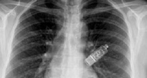 Implanted cardiac monitors successful with undiagnosed AF CardiacMonitor