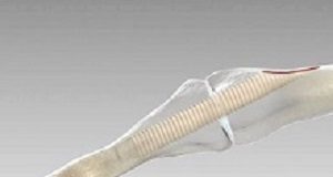 Successfully using surgical screws from donated human bone BoneScrew