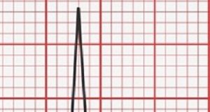 ECG detects difference between depression and bipolar symptoms ECGDepression