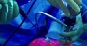 Groundbreaking operation on spina bifida foetus SpinaBifida