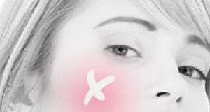 Improved healing for drained skin abscesses with trimethoprim-sulfamethoxazole MB-184 abscess.jpg