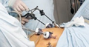 Bariatric surgery link to reduced mortality risk in obese patients Portrait of gastric bypass surgery in hospital