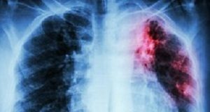 Will Ramaphosa put TB back on the radar? Tuberculosis