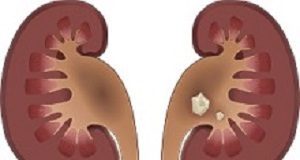 Urologists make SA history with high-tech kidney stone removal Kidneystones