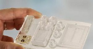 Chip-based blood test for multiple myeloma may relegate bone biopsy Myeloma