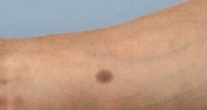 Artificial mole as an early warning of cancer mole