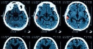 Blood loss drug helps intracerebral haemorrhage patients Intracerebral