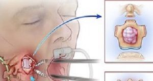 First-in-world robot-assisted spinal surgery PennStaterobot