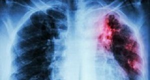 Funding allocated to TB 'pitiful' in comparison to HIV Pulmonary