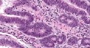 Ground-breaking immunotherapy clears advanced breast cancer Tumour