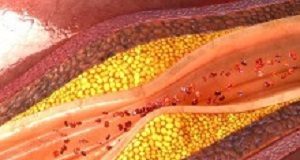 Study shows new technology can predict fatal heart attacks Coronary