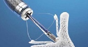 Clip sharply reduces death rates in patients with heart failure MitraClip