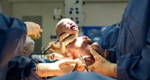 Surge in the number of C-sections around the world Baby being born via Caesarean Section coming out
