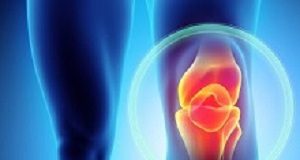 Why knee joint injury leads to osteoarthritis Knee painful