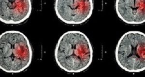 Simple test predicts stroke recovery over three years Stroke