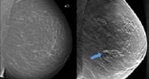 3D mammograms detect more invasive breast cancers tomosynthesis