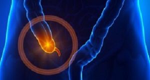 Link between appendix removal and development of Parkinson's Appendix