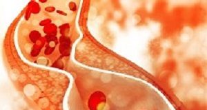 The rise and rise of the cholesterol deniers Cholesterol plaque in artery