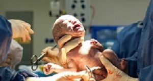 Caesarean rates are rocketing in SA Baby