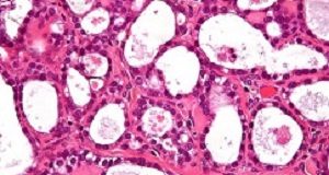 Breakthrough AI tools to detect cancers in women Carcinoma