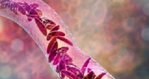 Gene therapy: A game changer for those with sickle-cell disease Sickle