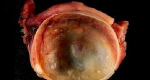 'Watchful waiting' rather than surgery for benign ovarian cysts Ovariancyst