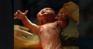 C-sections carry much higher mortality risk in Africa Caesarian