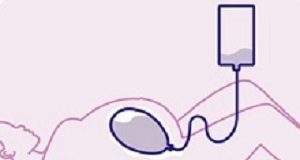 Cape Town gynae invents device to staunch post-birth bleeding Ellavi