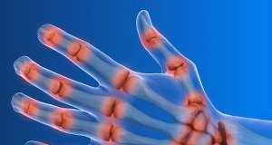 Stimulation of vagus nerve to treat rheumatoid arthritis pain Arthritis