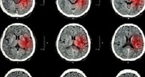 Working long hours linked with increased stroke risk Stroke