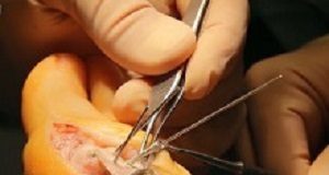 Disruptive magnesium-based, bone-bracing technology — A new 'gold standard'? MagneziX