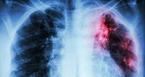 Ingestible sensor could revolutionise TB treatment MustRead