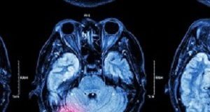 CRASH-3: a win for patients with traumatic brain injury Head