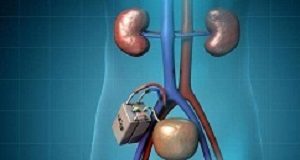 Implantable bio-artificial kidney achieves pre-clinical milestone Kidney
