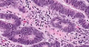 Immunotherapy boosts survival in prostate cancer 'super survivors' Immunotherapy