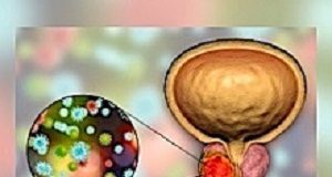 Decades-old antidepressant may fend off prostate cancer's return Prostate