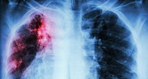 Rate of TB recurrence increases almost 9-fold over 13 years in Cape Town Pulmonary