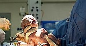 Women who deliver by C-section are less likely to conceive again